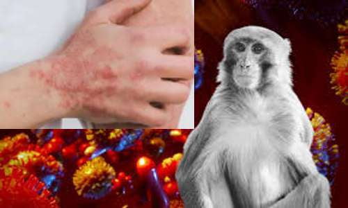 Emergencia de Salud Pública mundial por la viruela del Mono; en México hay 55 casos
